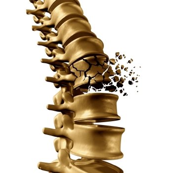 Spinal Fracture and traumatic vertebral injury medical concept as a human anatomy spinal column with a broken burst vertebra due to compression or other osteoporosis back disease on a white background.