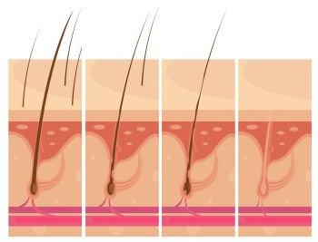 Hair Loss Skin Concept. Hair loss storyboard conceptual compositions set with profile macro view of balding scalp skin infographic images vector illustration