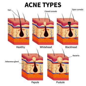 Acne types. Pimple skin diseases anatomy medical vector diagram. Illustration of follicle and pimple, medicine anatomy, papule and pustule. Acne types. Pimple skin diseases anatomy medical vector diagram