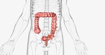 Diverticulosis occurs when small, bulging pouches develop in your digestive tract. 3D rendering. Diverticulosis occurs when small, bulging pouches develop in your digestive tract.