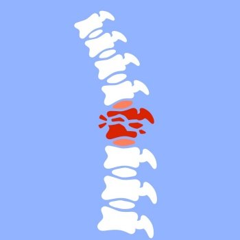 X-ray of internal organs. Medical care. Fracture of intervertebral discs. Crack in the White bone. Cartoon flat illustration. Problems with spine. Posture issues.