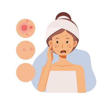 problem skin concept. Woman with pimples on her face,facial skin troubled. flat vector cartoon character illustration.