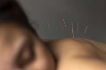 close up patient during acupuncture procedure. Resolution and high quality beautiful photo. close up patient during acupuncture procedure. High quality beautiful photo concept
