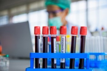 Blood sample research for vaccine corona virus in lab hospital