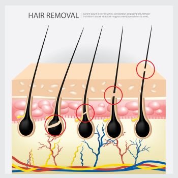 Hair Removal Example Vector Illustration