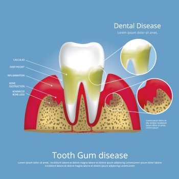 Human teeth Stages of Gum Disease Vector Illustration