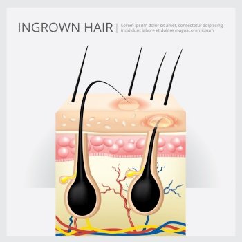 Ingrown Hair Structure Vector Illustration