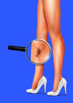 Female slim legs and varicose with health symbols vector realistic illustration. Female Legs And Varicose Realistic Illustration