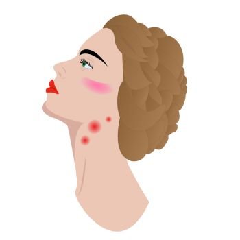 Swollen lymph  nodes disease in woman's neck lymphadenopathy, vector illustration isolated
