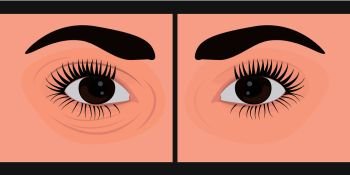 Dark circles under eyes to remove. Before and after. Vector illustration