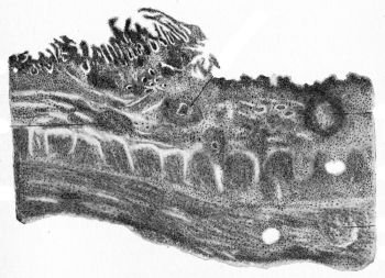 Margin of tubercular ulcer of the intestine, vintage engraved illustration.
