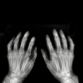 Hands on X-ray film