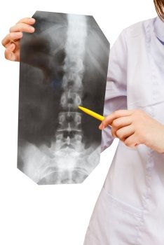 nurse shows X-ray picture with human spinal column isolated on white background